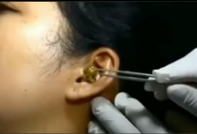 Surgeons struggle to remove live snake from woman's ear