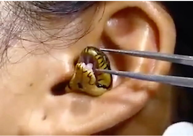 Surgeons struggle to remove live snake from woman's ear